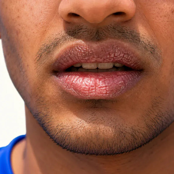 Dry mouth