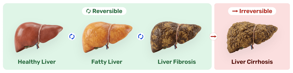 A Fatty Liver Slows Down Your Fat-Burning Engine